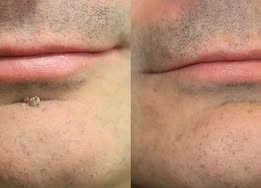 Hankihy® 2-in-1 Microneedle & Hydrocolloid Clear Patches  Targets Skin Tags, Flat Warts & Blemishes | Invisible Patch Technology for Face & Body