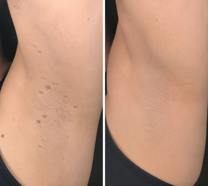 Hankihy® 2-in-1 Microneedle & Hydrocolloid Clear Patches  Targets Skin Tags, Flat Warts & Blemishes | Invisible Patch Technology for Face & Body
