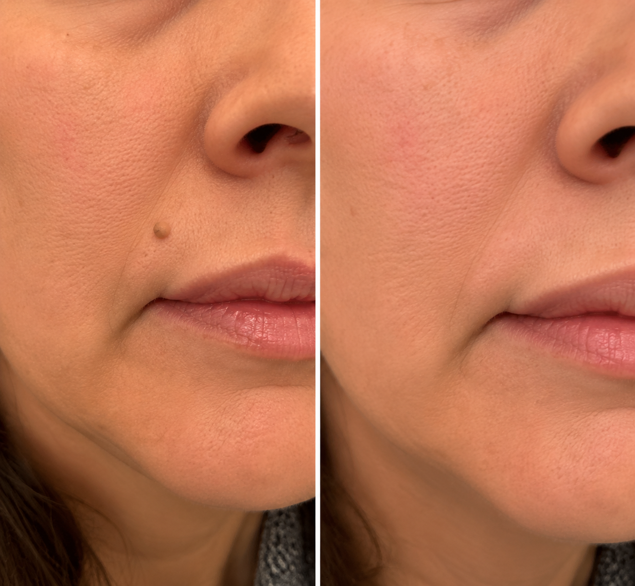 Hankihy® 2-in-1 Microneedle & Hydrocolloid Clear Patches  Targets Skin Tags, Flat Warts & Blemishes | Invisible Patch Technology for Face & Body