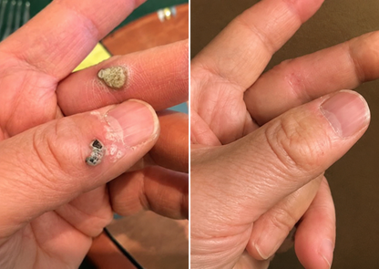 Hankihy® 2-in-1 Microneedle & Hydrocolloid Clear Patches  Targets Skin Tags, Flat Warts & Blemishes | Invisible Patch Technology for Face & Body